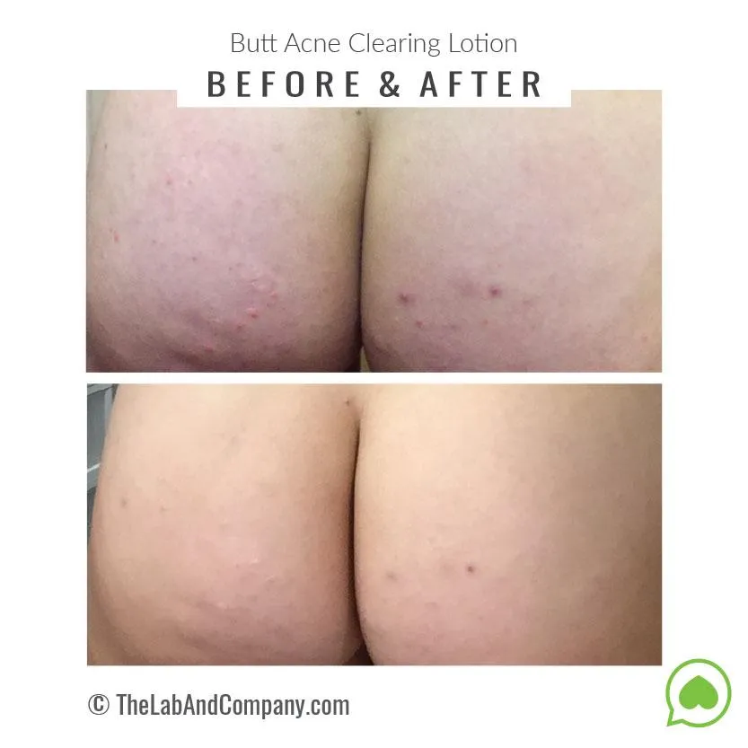 Brilliant Booty Kit | ExfoliMATE 2.0   Butt Acne Clearing Lotion