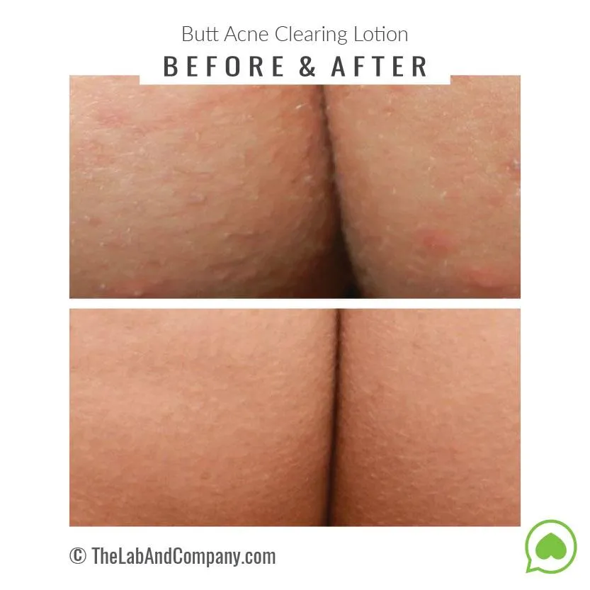 Brilliant Booty Kit | ExfoliMATE 2.0   Butt Acne Clearing Lotion