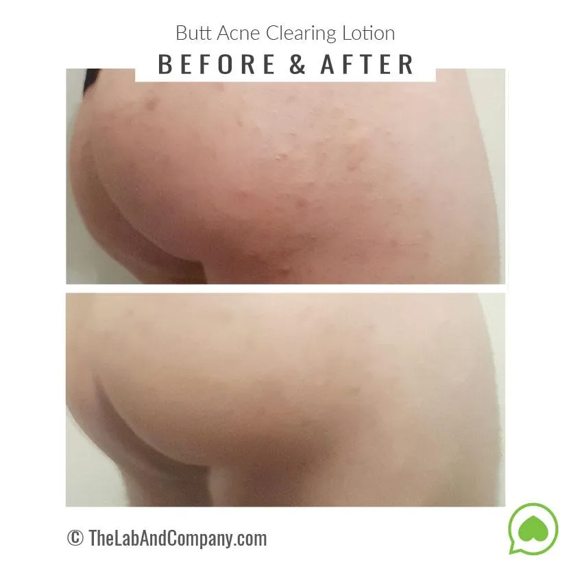 Brilliant Booty Kit | ExfoliMATE 2.0   Butt Acne Clearing Lotion